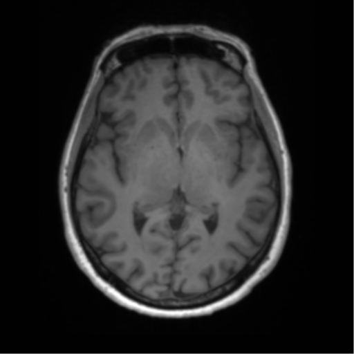 File:Anaplastic astrocytoma - thalamic glioma (Radiopaedia 59709-67115 Axial T1 14).png