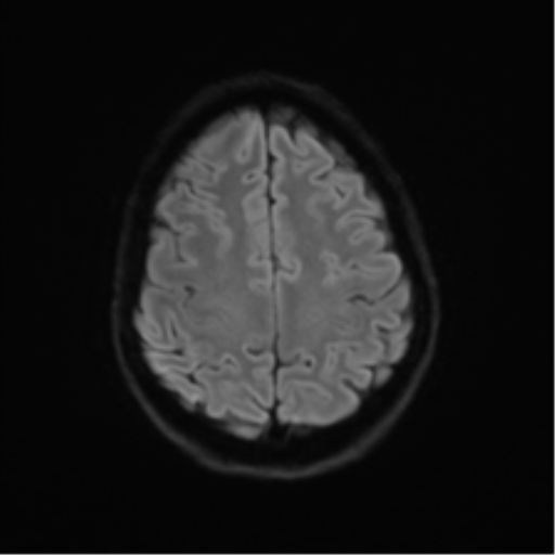 Anaplastic astrocytoma IDH mutant (Radiopaedia 50046-55341 Axial DWI 49).png