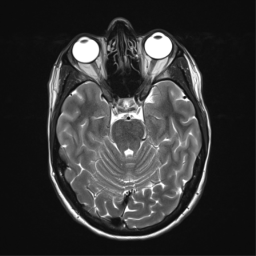 File:Anaplastic astrocytoma IDH mutant (Radiopaedia 50046-55341 Axial T2 14).png