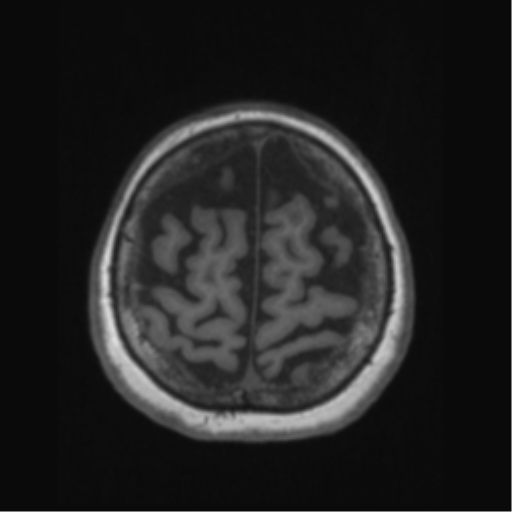 Anaplastic astrocytoma IDH wild-type (pseudoprogression) (Radiopaedia 42209-45276 Axial T1 127).png