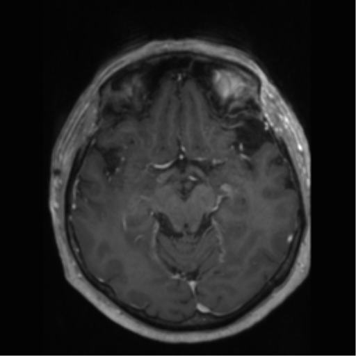 File:Anaplastic astrocytoma IDH wild-type (pseudoprogression) (Radiopaedia 42209-45277 Axial T1 C+ 49).png