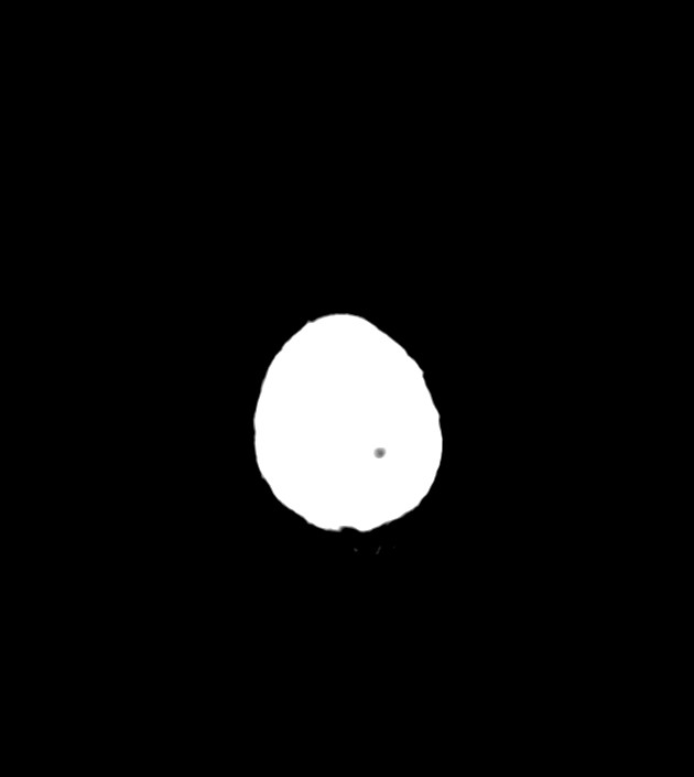 Anaplastic oligodendroglioma (Radiopaedia 79571-92753 Axial non-contrast 52).jpg