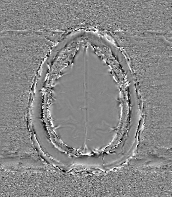 Anaplastic oligodendroglioma (Radiopaedia 83500-98599 Axial SWI - phase 75).png