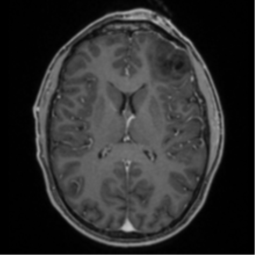 Anaplastic oligodendroglioma with skull fracture (Radiopaedia 74831-85845 Axial T1 C+ fat sat 35).png