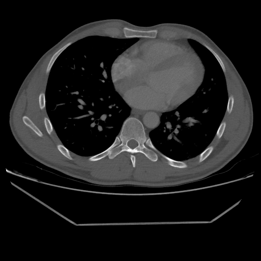 File:Aneurysmal bone cyst - rib (Radiopaedia 82167-96220 Axial bone window 165).jpg