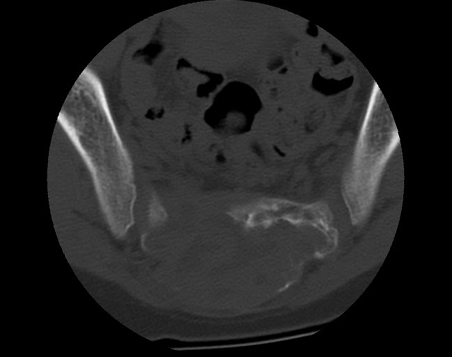 Aneurysmal bone cyst - sacrum (Radiopaedia 65190-74195 Axial bone window 30).jpg
