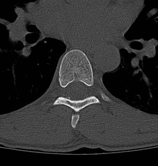Aneurysmal bone cyst T11 (Radiopaedia 29294-29721 Axial bone window 6).jpg