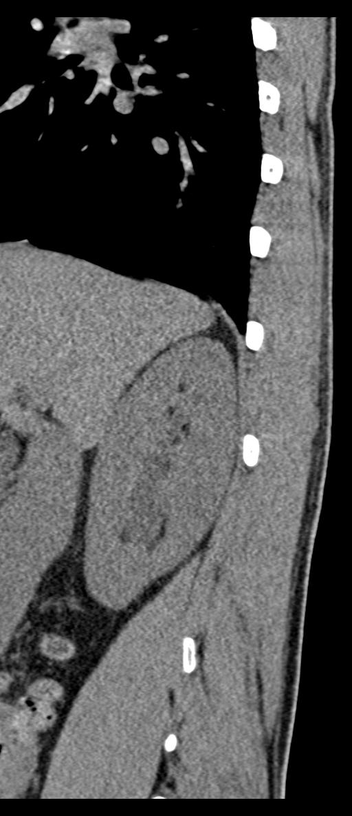 Aneurysmal bone cyst T11 (Radiopaedia 29294-29721 E 74).jpg