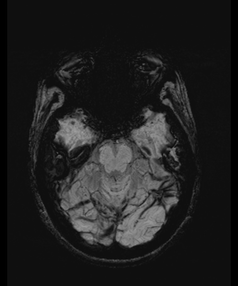Angiomatous meningioma (Radiopaedia 79459-92579 E 20).jpg