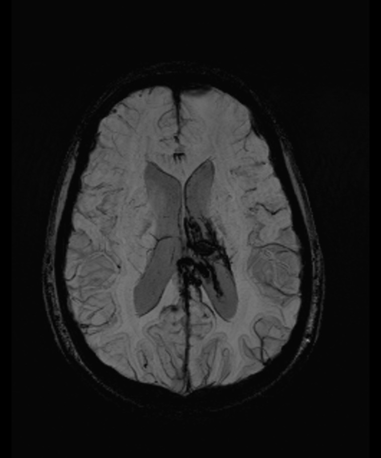 Angiomatous meningioma (Radiopaedia 79459-92579 E 39).jpg