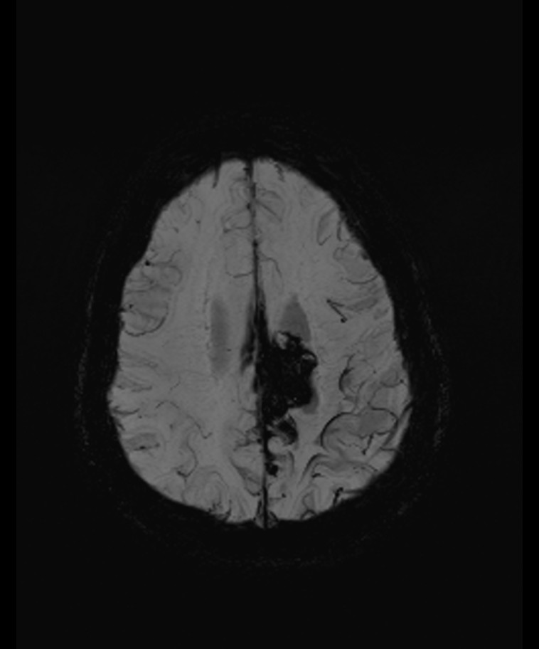 Angiomatous meningioma (Radiopaedia 79459-92579 E 49).jpg
