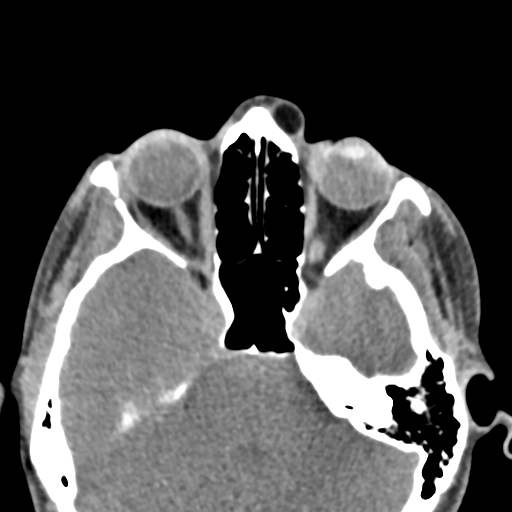 Angular dermoid cyst (Radiopaedia 88967-105790 Axial non-contrast 27).jpg