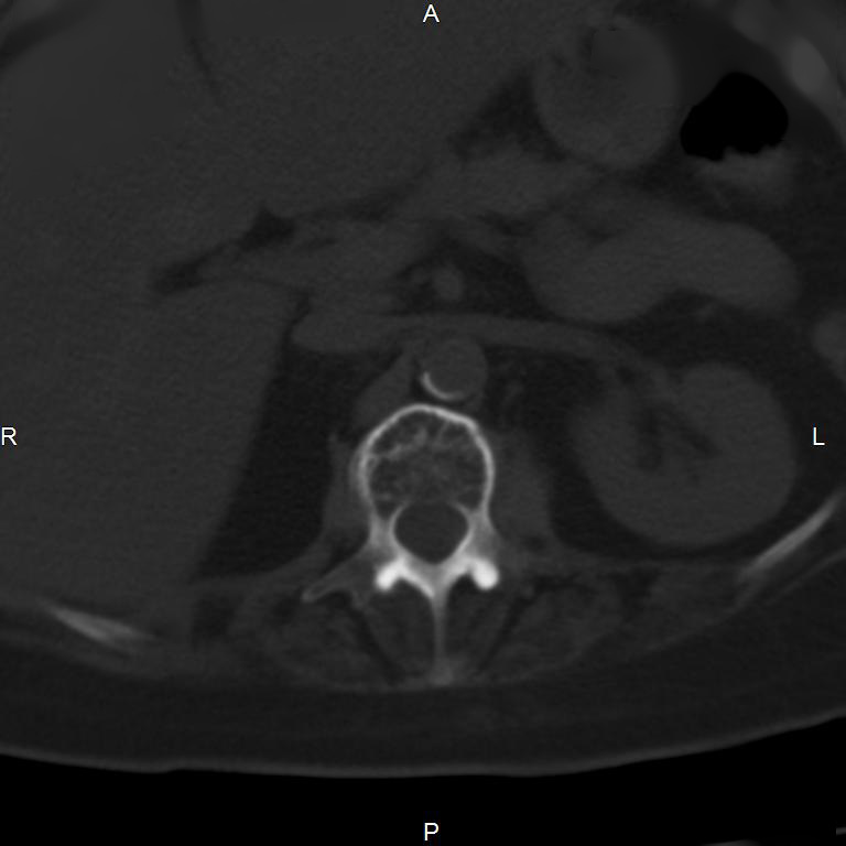 Ankylosing spondylitis (Radiopaedia 8748-9556 Axial bone window 21).jpg