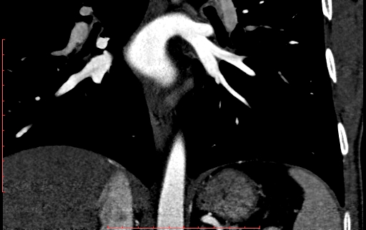 Anomalous left coronary artery from the pulmonary artery (ALCAPA) (Radiopaedia 70148-80181 B 233).jpg