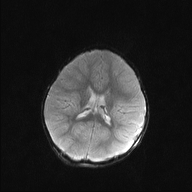 File:Anoxic brain injury (Radiopaedia 79165-92139 Axial DWI 15).jpg