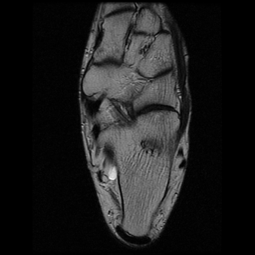 File:Anterior calcaneal process fracture (Radiopaedia 74654-85611 Axial T2 18).jpg