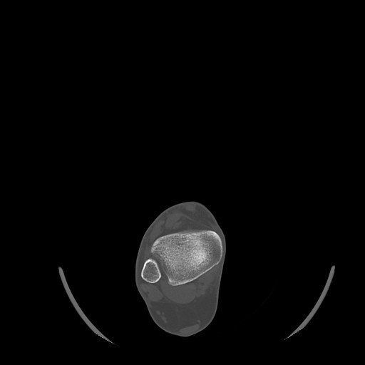 Anterior calcaneal process fracture (Radiopaedia 82590-96762 Axial bone window 9).jpg