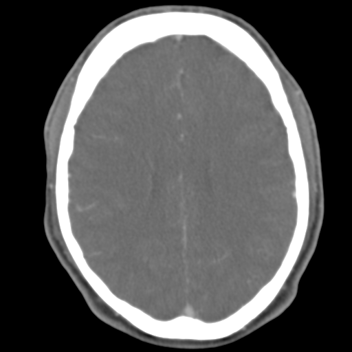 File:Anterior cerebral artery territory infarct (Radiopaedia 39327-41581 B 24).png