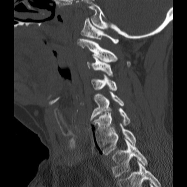 Anterior cervical postdiscectomy arthrodesis (Radiopaedia 32678-33646 Sagittal bone window 50).jpg