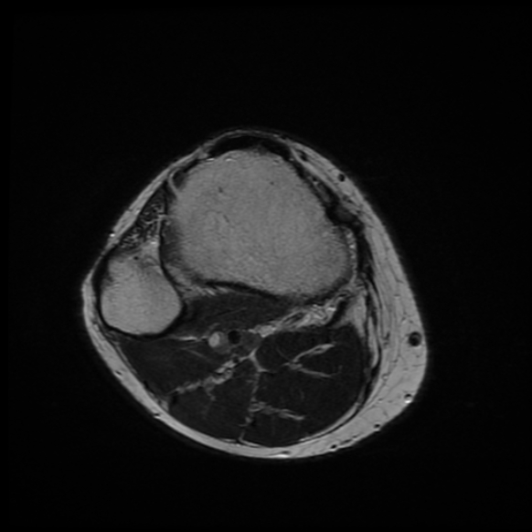File:Anterior cruciate ligament graft tear and bucket-handle tear of medial meniscus (Radiopaedia 75867-87254 Axial T2 2).jpg