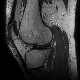 Anterior cruciate ligament rupture with Segond fracture (Radiopaedia 69043-78806 Sagittal PD 128).jpg
