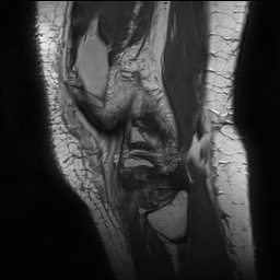 Anterior cruciate ligament rupture with Segond fracture (Radiopaedia 69043-78806 Sagittal PD 164).jpg
