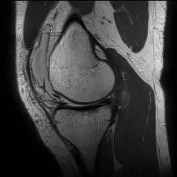 Anterior cruciate ligament rupture with Segond fracture (Radiopaedia 69043-78806 Sagittal PD 67).jpg