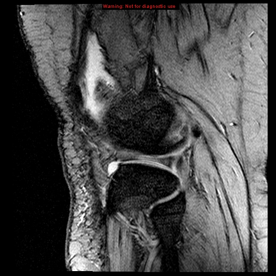 File:Anterior cruciate ligament tear (Radiopaedia 12329-12612 A 4).jpg