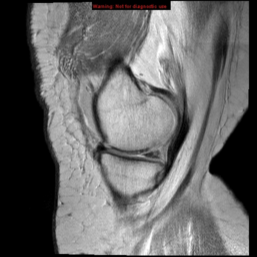 File:Anterior cruciate ligament tear (Radiopaedia 12329-12612 Sagittal T2 fat sat 16).jpg