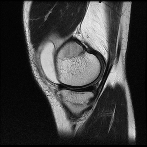 File:Anterior cruciate ligament tear (Radiopaedia 61500-69462 Sagittal T2 4).jpg