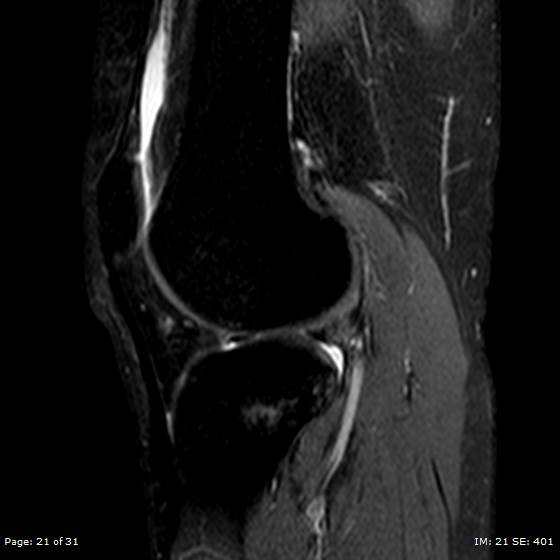 File:Anterior cruciate ligament tear (Radiopaedia 70783-80964 Sagittal STIR 21).jpg