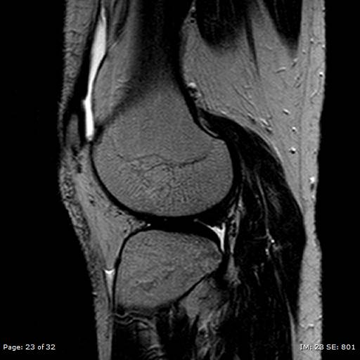 File:Anterior cruciate ligament tear (Radiopaedia 70783-80964 Sagittal T2 23).jpg