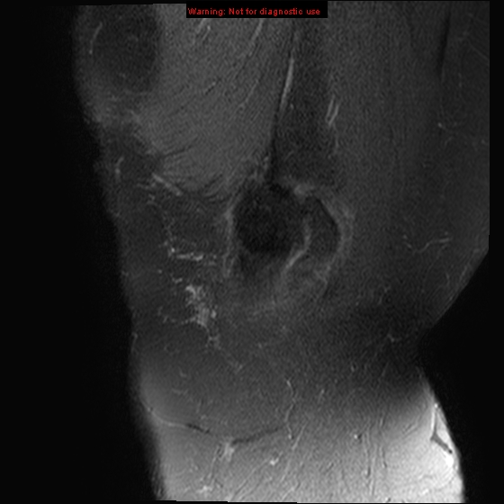 File:Anterior cruciate ligament tear - complete (Radiopaedia 12175-12514 Sagittal T2 fat sat 21).jpg