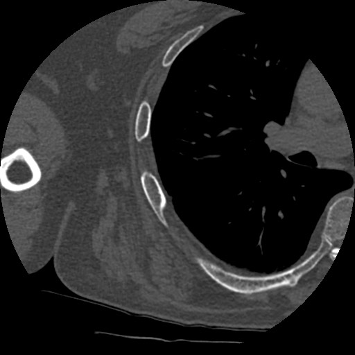 Anterior glenohumeral dislocation with Hill-Sachs lesion (Radiopaedia 62877-71249 Axial bone window 91).jpg
