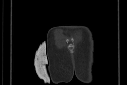 Anterior inferior iliac spine avulsion injury (Radiopaedia 88666-105376 Coronal bone window 71).jpg
