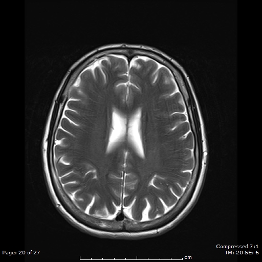 File:Anterior temporal lobe perivascular space (Radiopaedia 88283-104914 Axial T2 20).jpg