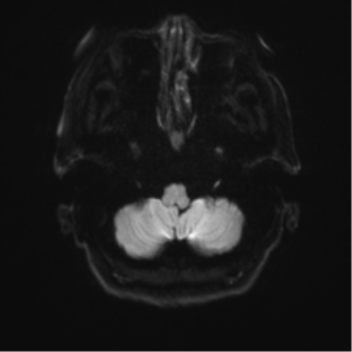 Anterior temporal pole cysts (Radiopaedia 46629-51102 Axial DWI 31).png