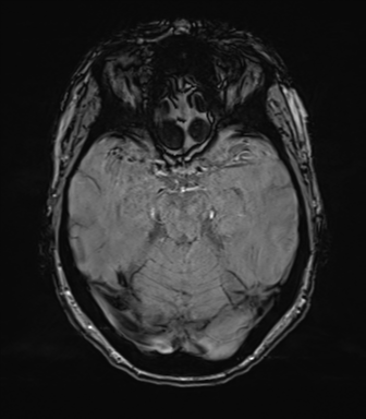 Anterior temporal pole cysts (Radiopaedia 46629-51102 Axial SWI 34).png