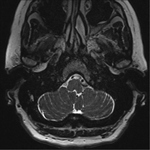 Anterior temporal pole cysts (Radiopaedia 46629-51102 Axial T2 8).png