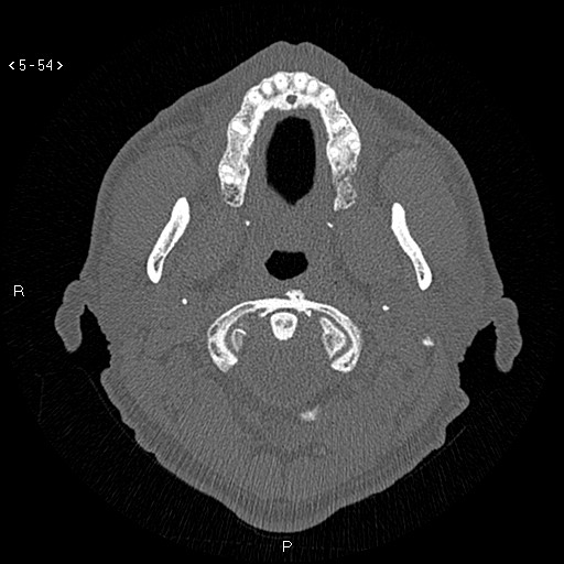 Antrochoanal Polyp (Radiopaedia 70510-80631 Axial bone window 2).jpg