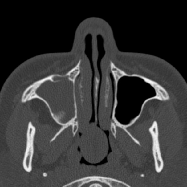 Antrochoanal polyp (Radiopaedia 33984-35202 Axial bone window 17).jpg