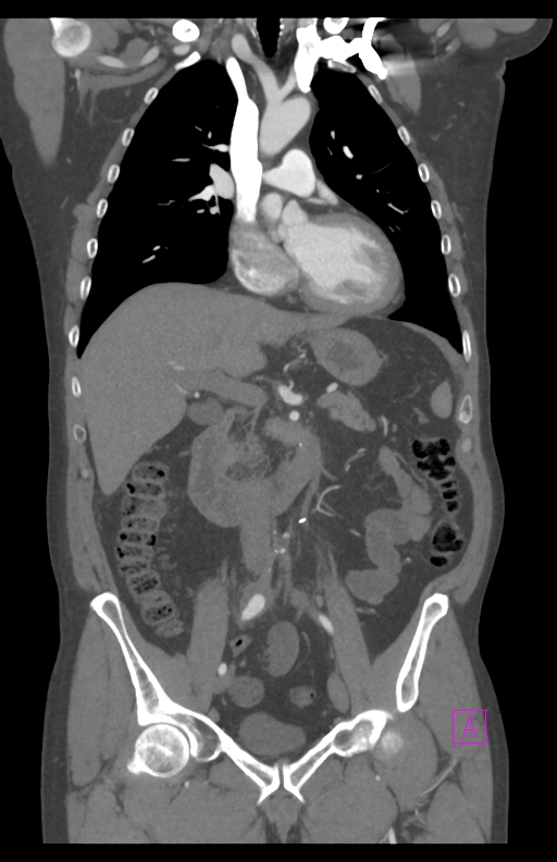 Aortectomy and axillary-bifemoral bypass (Radiopaedia 28303-28545 C 43).jpg