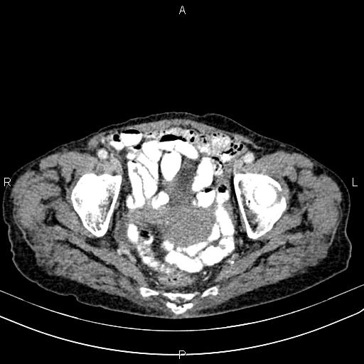 Aortic aneurysm and Lemmel syndrome (Radiopaedia 86499-102554 A 71).jpg