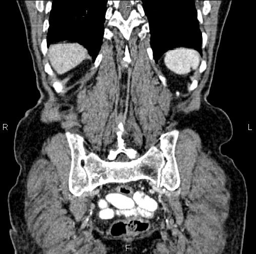 Aortic aneurysm and Lemmel syndrome (Radiopaedia 86499-102554 C 55).jpg