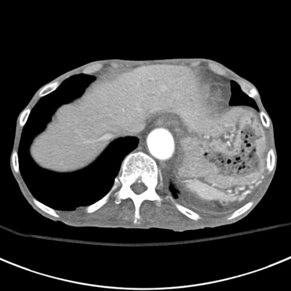 File:Aortic aneurysm with spinal destruction (Radiopaedia 42301-45410 A 13).jpg