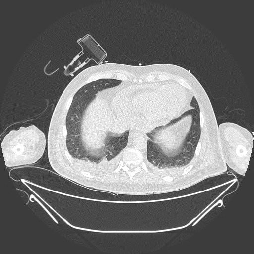 Aortic arch aneurysm (Radiopaedia 84109-99365 Axial lung window 217).jpg