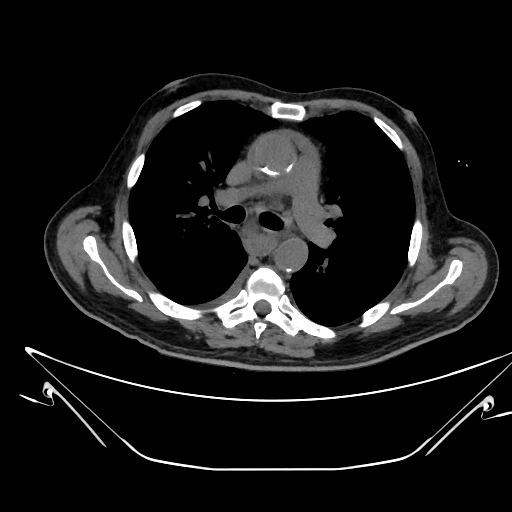 File:Aortic arch aneurysm (Radiopaedia 84109-99365 Axial non-contrast 120).jpg