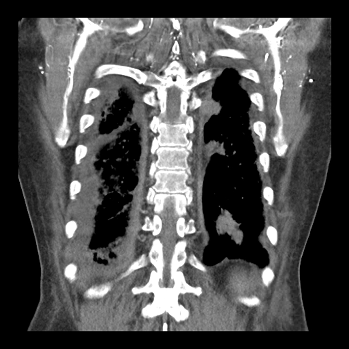 Aortic arch graft infection (FDG PET-CT) (Radiopaedia 71975-82437 Coronal 50).jpg