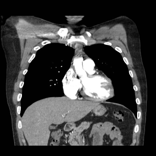 File:Aortic arch stent (Radiopaedia 30030-30595 F 3).jpg