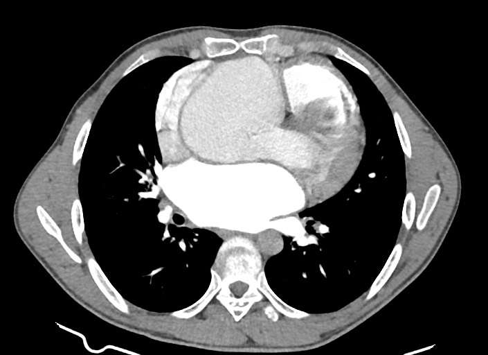 File:Aortic coarctation with aneurysm (Radiopaedia 74818-85828 A 103).jpg